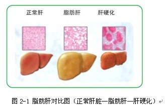 脂肪肝对比图